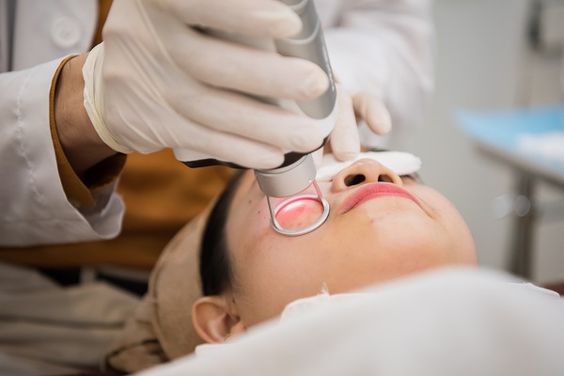 Phương pháp Laser vi điểm trị sẹo đáy nhọn