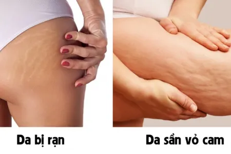 Da sần vỏ cam ở mặt