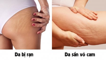 Da sần vỏ cam ở mặt