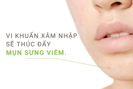 điều trị mụn trứng cá