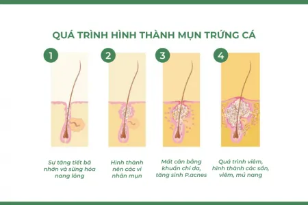 quá trình hình thành mụn viêm