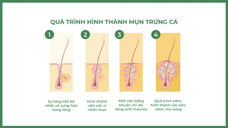 quá trình hình thành mụn viêm